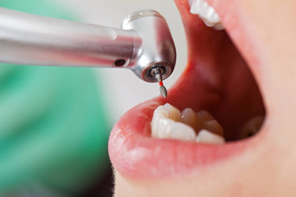 Best Chipped Tooth Repair Near Me  in Jackpot, NV
